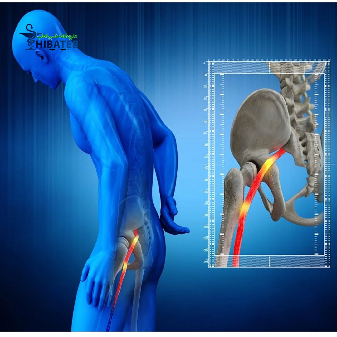 علائم و درمان درد عصب سیاتیک چیست؟